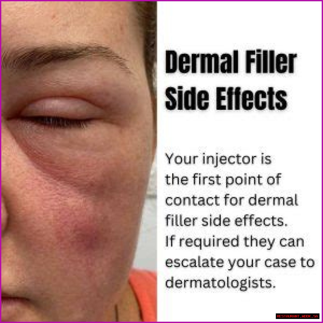 Understanding Botched Fillers: Causes, Consequences, And Solutions